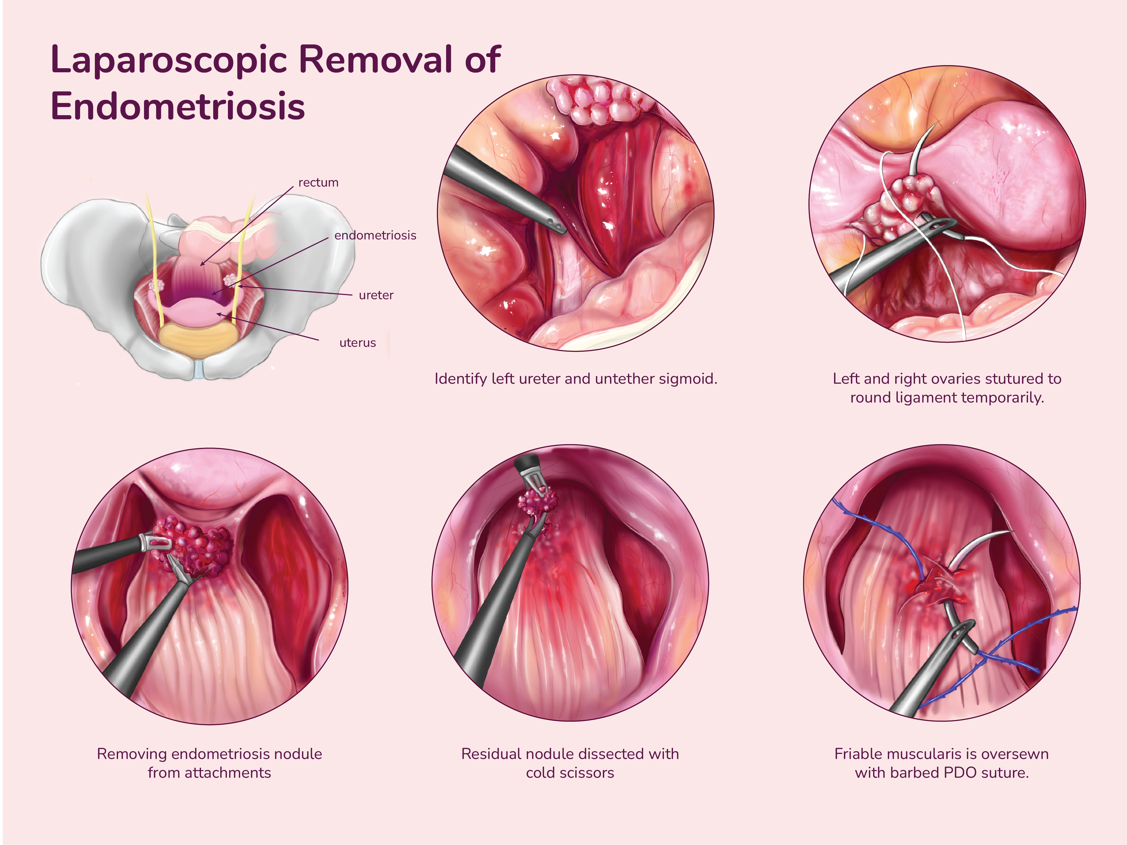 Laparoscopic Removal of Endometriosis